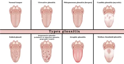 Глоссит: специфика заболевания и современные методы лечения