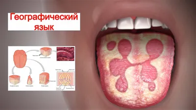 Десквамативный глоссит | MedicalInfo | Дзен