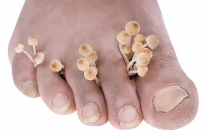 Микозы после отдыха: грибковые инфекции кожи и ногтей. | Медицинский центр  «Чистая Кожа» | Дзен