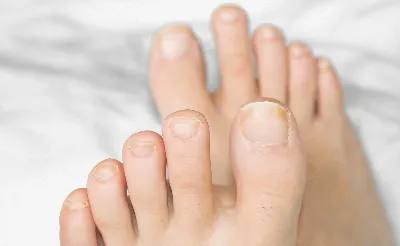 Как выявить грибок на ногах и руках: симптомы и способы лечения | doc.ua