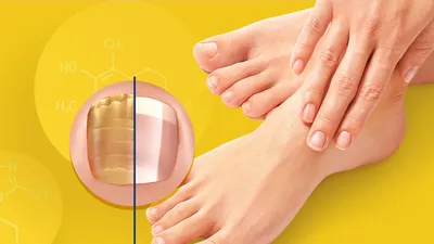 Онихомикозы - грибковые заболевания ногтей - Ева Арт