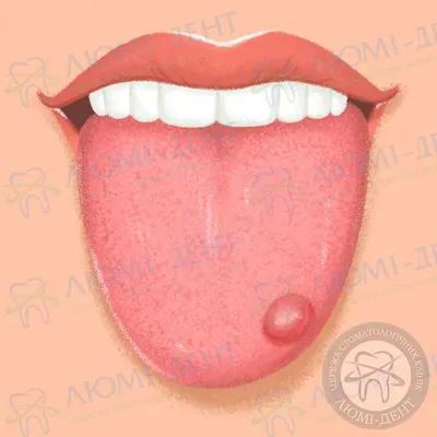 Почему опухает язык с горлом или губами, что делать в этом случае