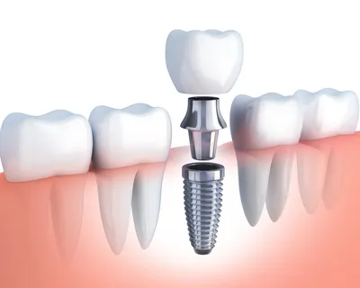 Имплантация зубов - Стоматологическая клиника Дзен
