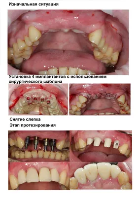 Имплантация зубов - Стоматология Дубровины