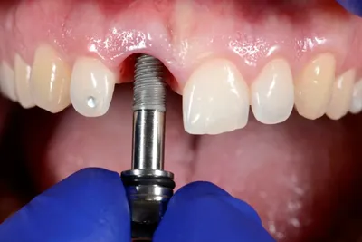 Что такое одноэтапная имплантация зубов?
