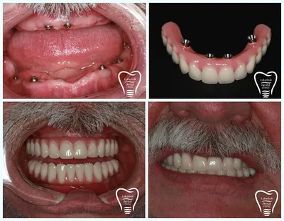 Безоперационная имплантация зубов | Этапы и преимущества | Клиника семейной  стоматологии Дока-Дент