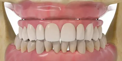 Имплантация зубов | dr. Weber