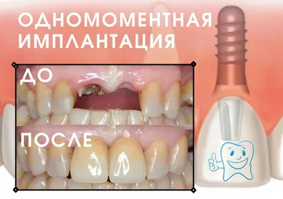 Имплантация зубов в Перми - Стоматология Visual Dental