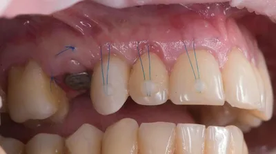 Одномоментная имплантация одного зуба | Стоматология Улыбка