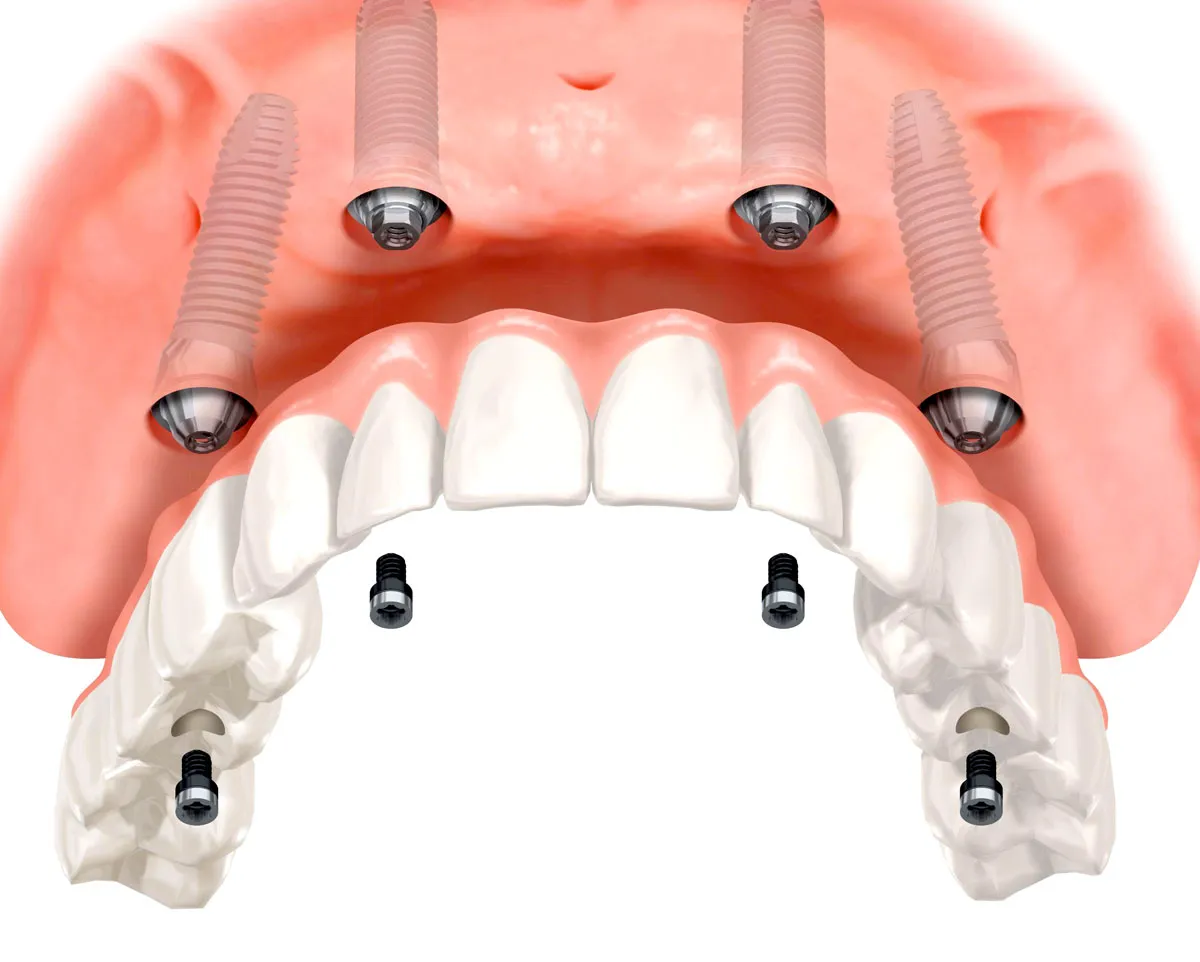 Имплантологическая кассета Nobel полный набор для all on 4. Имплантация верхней челюсти на 4 имплантах. Условно съемный протез на 4 имплантах. Имплантация челюсти на 4 имплантах. Имплантация зубов all on 6