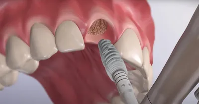 Имплантация зубов после удаления - Cтоматология Май