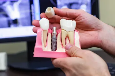 Имплантация зубов под ключ в Челябинске - цены и акции на зубные импланты