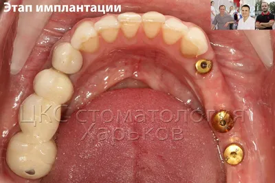 Базальная имплантация зубов стоматологическая клиника Эстетика
