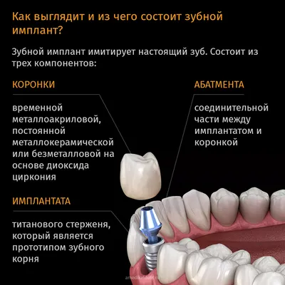 Имплантация зубов под ключ 💎 стоимость установки зубных имплантов -  Денталюкс Рязань