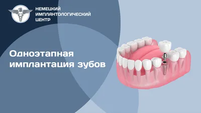 Недорогая имплантация зубов в г. Челябинск с максимальной гарантией