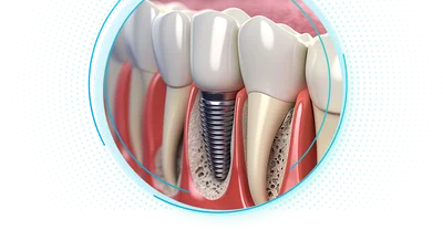 Протезирование жевательных зубов с опорой на зубные имплантаты