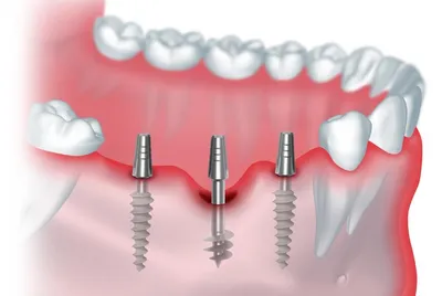 Имплантация зубов от 18 000 руб — цены на установку имплантов в Люберцах и  Жулебино
