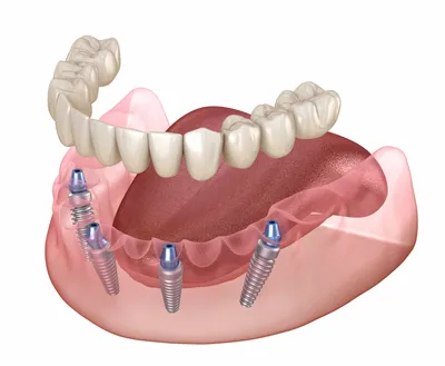 Имплантация зубов цены в Ногинске, стоимость установки зубного имплантата