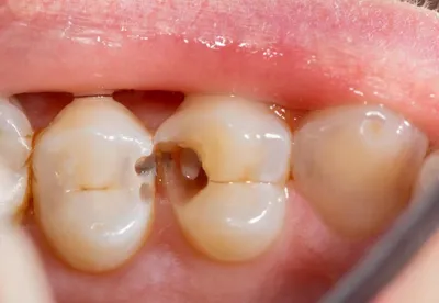 Глубокий кариес - Терапевтическая стоматология - «Аксиома Дентал»