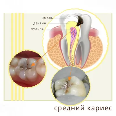 Лечение кариеса: стоимость, виды, симптомы | стоматология Нардент(МСК)