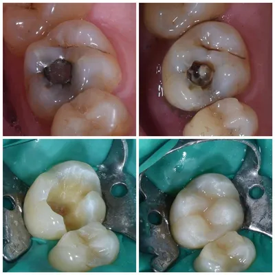 Кариес под пломбой | Работы врача-стоматолога Грыцив Э. И. | Наши работы