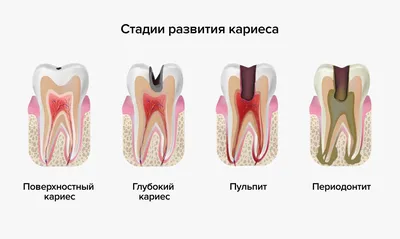 Способы лечения поверхностного кариеса