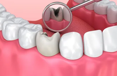 Кариес – это процесс гниения, разрушающий твердые зубные ткани. Начальный  кариес протекает незаметно, но уже на второй стадии человек может… |  Instagram
