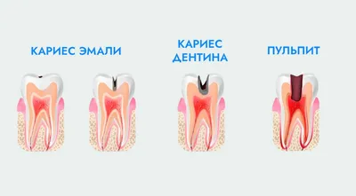 Кариес зуба - причины кариеса зубов, стадии развития и факторы риска