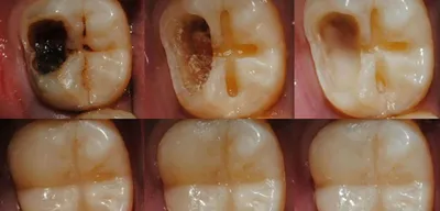 Кариес на контакте: выполненная работа с фото до и после в стоматологии  OneDent