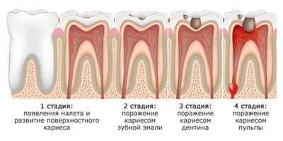 глубокий кариес – причины, этиология, методы лечения