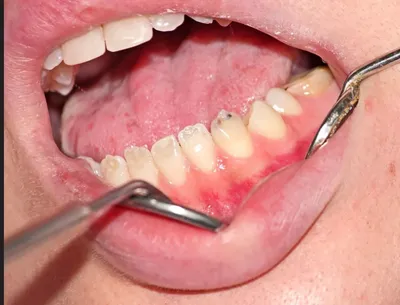 Кариес корня зуба- симптомы, причины, методы лечения кариеса зуба