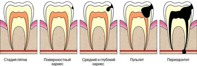 Пришеечный кариес. Диагностика, лечение, профилактика, стадии...