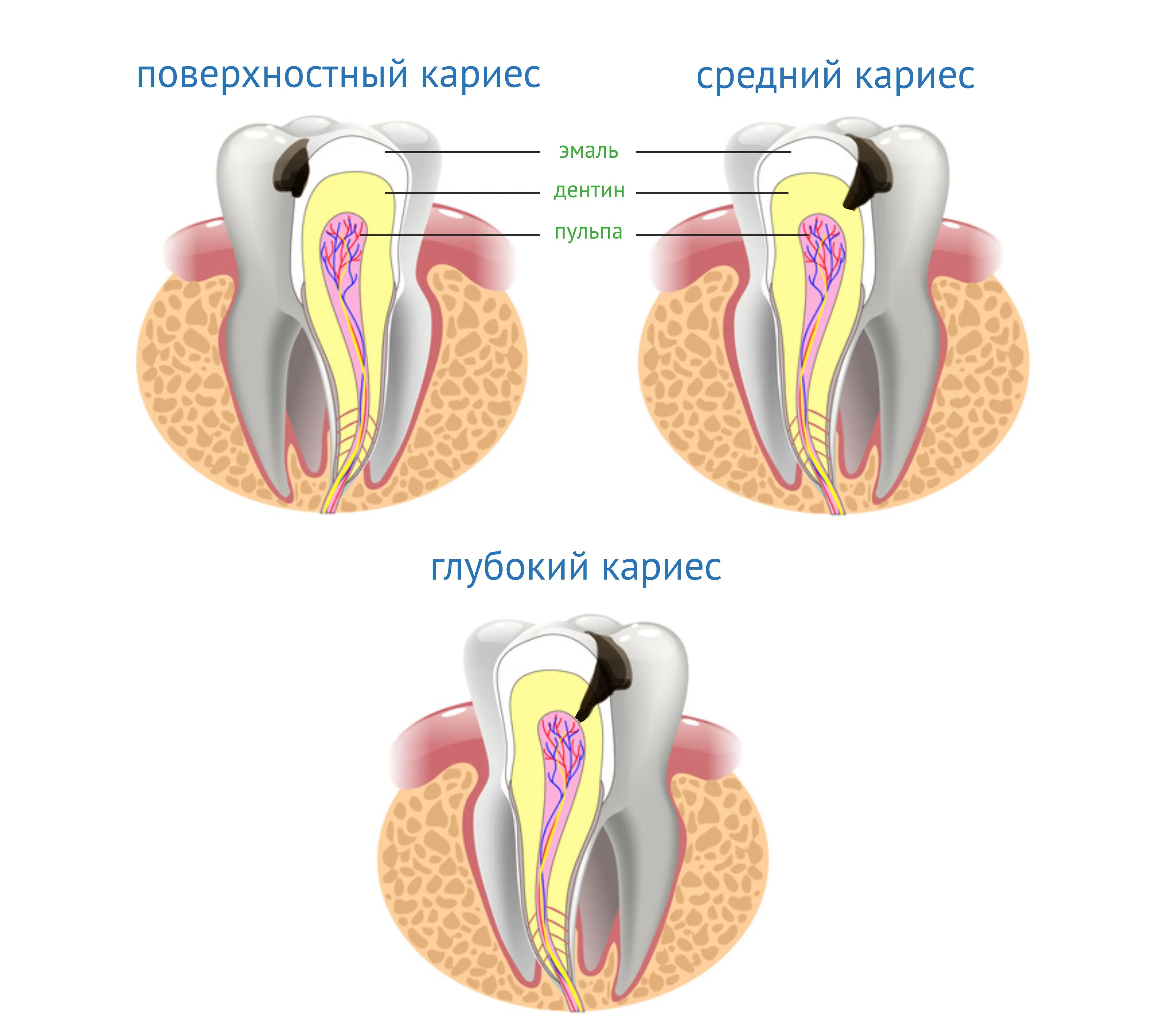 Чем можно обработать зуб. Поверхностный средний и глубокий кариес.