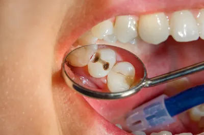 Лечение кариеса в стоматологической клинике \"Доктор Про\"