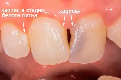 Лечение кариеса в Перми без боли | Безболезненное лечение кариеса в  стоматологии | ООО «Стоматологическая клиника «Венеция», г. Пермь