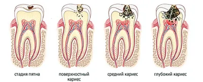 Фотографии лечения глубокого кариеса