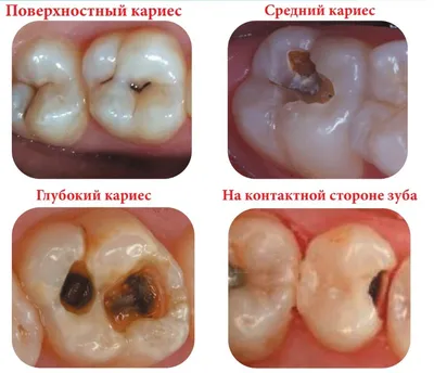 Кариес зубов - чем опасен, лечение и профилактика - silk