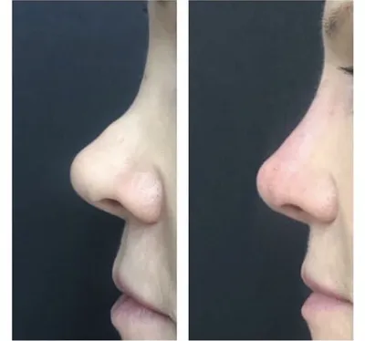 Почему закладывает нос, как с этим бороться?: как быстро и правильно  вылечить сильный насморк у взрослого