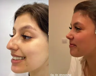 Новый нос. Три месяца спустя. Дневник пациентки | Beauty Insider