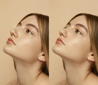 Как уменьшить нос филлером - как убрать горбинку на носу без операции -  отзывы, фото до и после