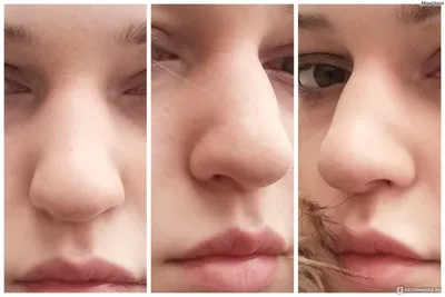 Нос до и после ринопластики (безоперационной)
