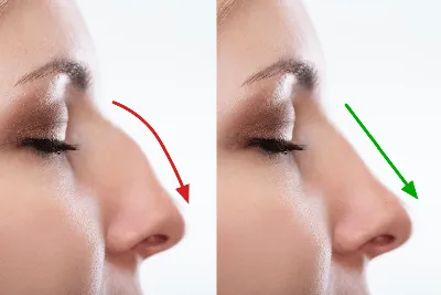 Нос с горбинкой — как исправить? - Центр пластической хирургии Daily Medical