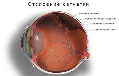 Глаукома – что это, симптомы, причины возникновения, виды, диагностика,  лечение и профилактика