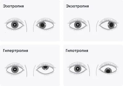 Лечение косоглазия у детей в Санкт-Петербурге • Офтальмологический центр  «Зрение»