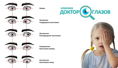 Офтальмологическая клиника «Смотри» - Косоглазие