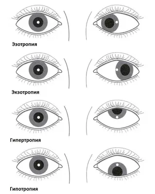 Лечение косоглазия. Компания АртОптика г. Челябинск