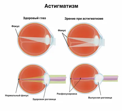 Что такое астигматизм и можно ли от него избавиться - Лайфхакер