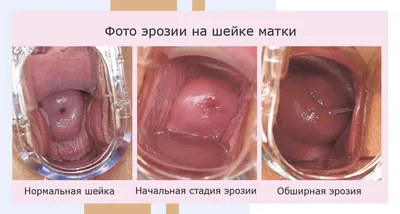 Картинки эрозии