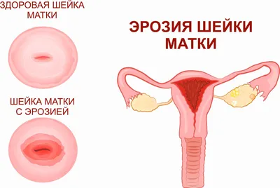 Эрозия шейки матки - причины, симптомы, диагностика и лечение