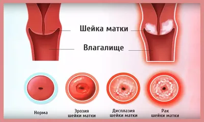 Последствия прижигания эрозии шейки матки | Анна-Мария Кравченко | Дзен